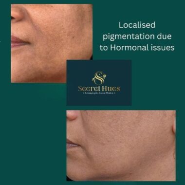 Uneven Skin Tone: Causes and Fixes